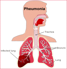 Pneumonia simptome tipuri tratament