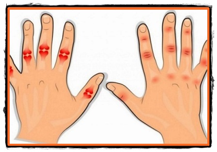 noduli pe degete pentru artrita)
