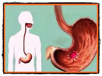 Ulcerul gastro-duodenal,tratamente si remedii naturale