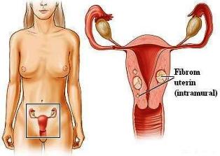 Tratamente pentru fibrom uterin